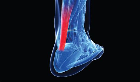 Achilles Tendon Tear Mri