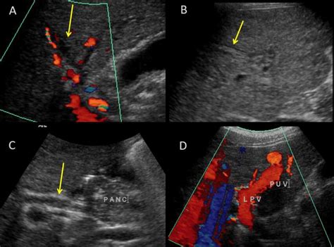 Examples Of Ultrasound Findings In Psc A In This Image There Is Download Scientific Diagram