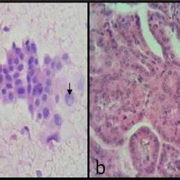 (a) Case was diagnosed as atypia of undetermined significance due to... | Download Scientific ...