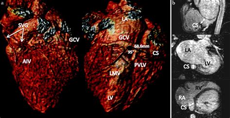 083 Coronary Vein And Myocardial Scar Imaging With A Single Cardiac Mri