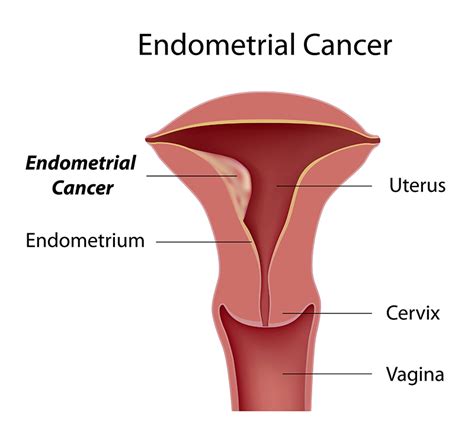 Endometrial Cancer Treatment And Surgery In Bangalore