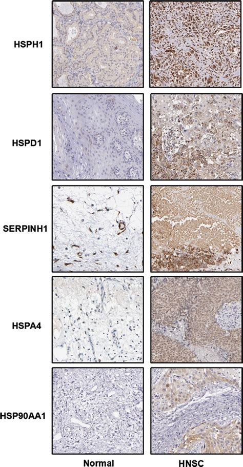 Hsp Genes Were Distinctively High Expressed In Hnsc Tissues From Human