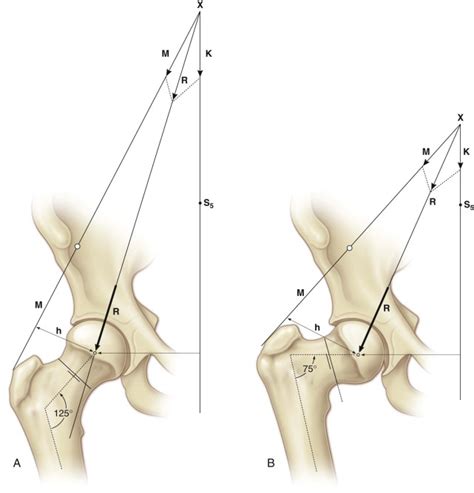 Congenital Coxa Vara | Musculoskeletal Key