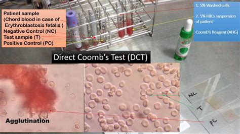 Direct Coomb Test Dct Introduction Principle Procedure Result Interp