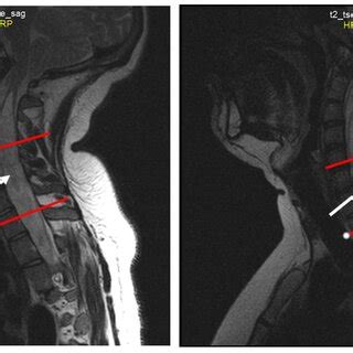 Sequential Sagittal T2 Weighted MRI Scans Of The Cervical Spine