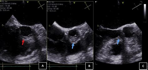 Subaortic Stenosis What Lies Beneath Case