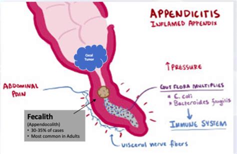 Peds Gi Flashcards Quizlet