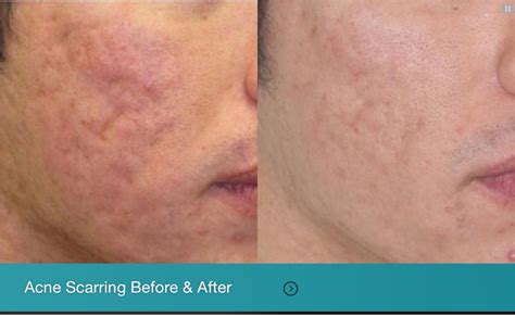 Fractional Laser Resurfacing Horizon Dermatology And Cosmetic Center