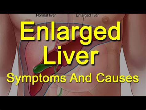 Enlarged Liver