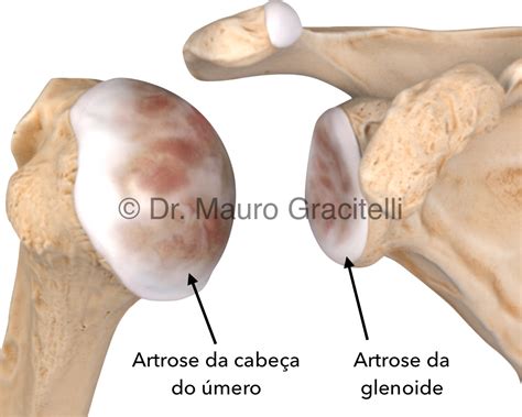 Artroplastia Do Ombro Dr Mauro Gracitelli