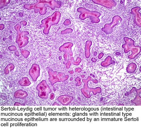 Pathology Outlines Sertoli Leydig Cell Tumor