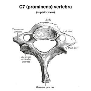 Vertebra Prominens