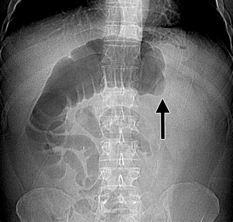 Large Bowel Obstruction In The Adult Classic Radiographic And Ct