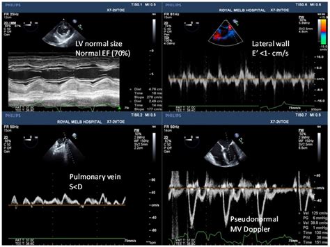 Evaluation Of Left Ventricular Diastolic Function By Echocardiography Intechopen