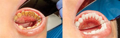 Severe Gingivitis Before And After