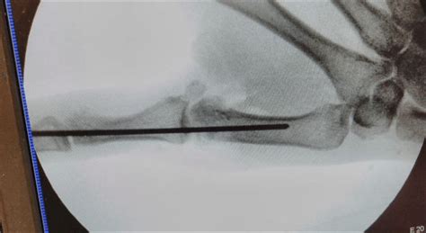 Intraoperative fluoroscopic picture showing reduced first MCP joint ...