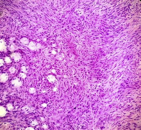 Representative Histologic Features On Frozen Sections From The First