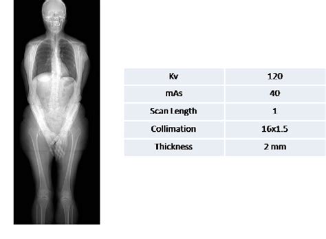 Figure 1 From Diagnostic Value Of Whole Body Low Dose Computed