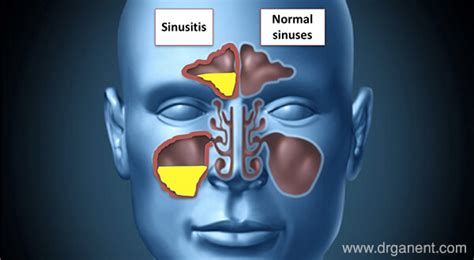 Sinus And Sinusitis What Is The Difference Dr Gan Eng Cern