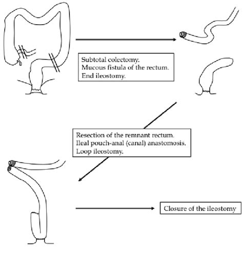 Fig. 1. Three-stage restorative proctocolectomy for severe ulcerative colitis | Scientific Diagram