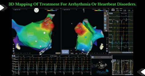 3d Mapping Of Treatment For Arrhythmia Or Heartbeat Disorders Cardiologist Indore