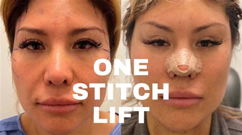 One Stitch Lift SCARLESS FACE LIFT YouTube