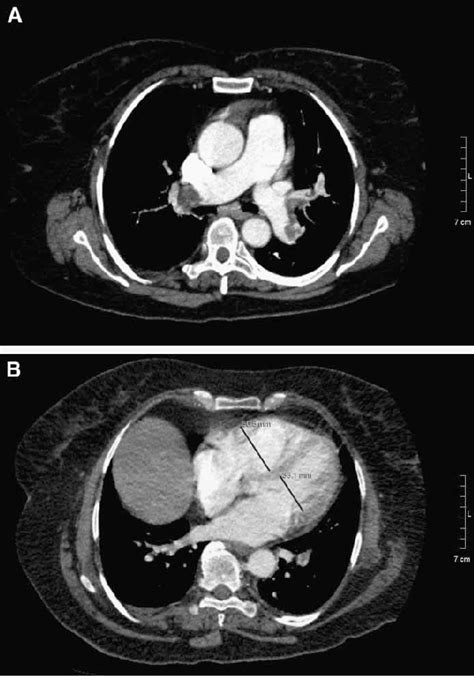 Figure 1 From Computed Tomographic Pulmonary Angiography In The Assessment Of Severity Of Acute