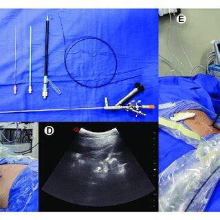 PDF Performing Percutaneous Nephrolithotomy Under Modified Local