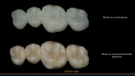 Чем отличаются друг от друга разные керамические коронки ...