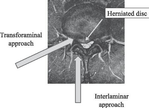 Pdf State Of The Art Transforaminal Approach For Percutaneous