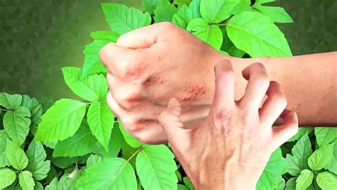 What Makes The Urushiol Compound Of Poison Ivy Cause An Allergic