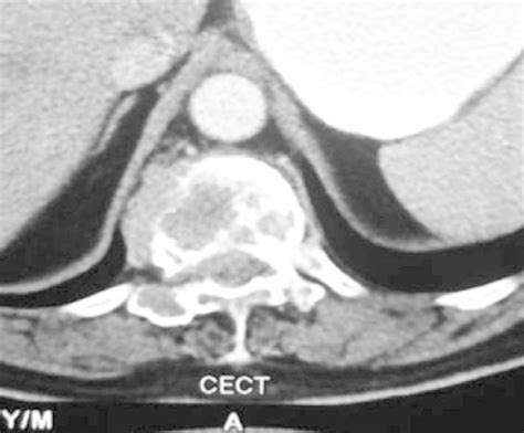 Contrast Enhanced Computed Tomography Scan Revealing Heterogeneously