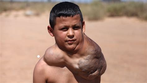 Ten Year Old Has Giant Neck Tumour Body Bizarre Episode Youtube