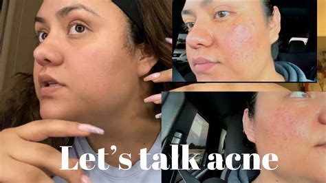 How I Cleared Up My Acne Prone Skin Using These Products Youtube