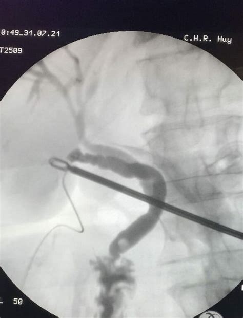 La cholécystectomie par laparoscopie à Huy Espace Médico Chirurgical emc²