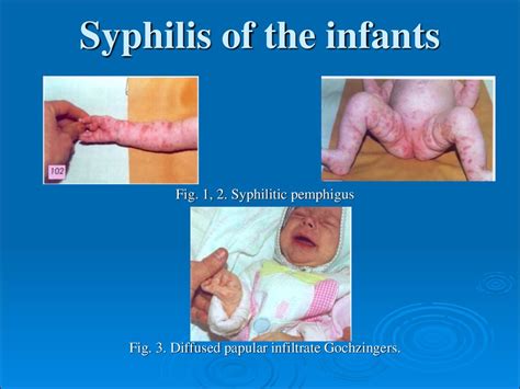 Tertiary Visceral Syphilis Neurosyphilis презентация онлайн