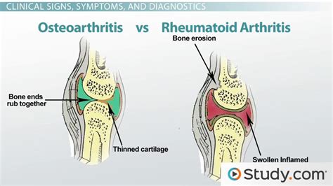 What is Rheumatoid Arthritis? - Causes, Symptoms & Treatment - Lesson | Study.com