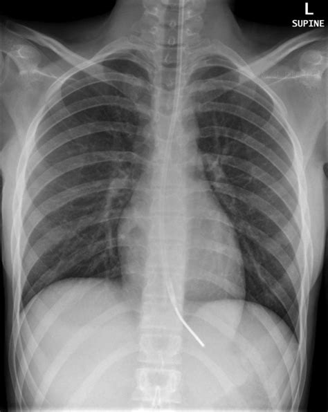 Assessing Nasogastric Ng Tube Placement Geeky Medics