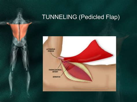 Latissimus Dorsi Flap For Reconstruction In Head And Neck Deffects Ppt