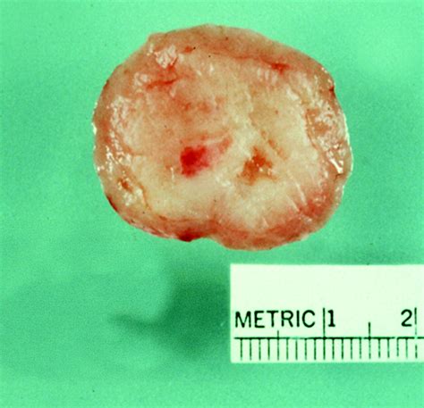 Multimodality Imaging Of Paratesticular Neoplasms And Their Rare Mimics