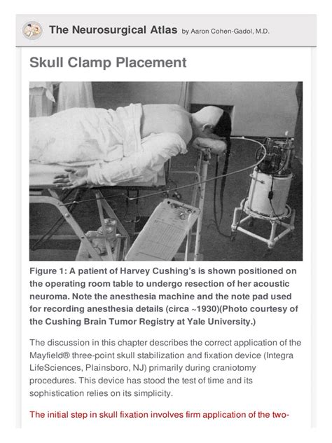 Skull Clamp Placement The Neurosurgical Atlas Download Free Pdf Skull Anatomical Terms Of