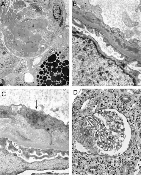 Representative Examples Of Acute Proliferative Glomerulonephritis A Download Scientific