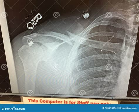 Broken Collar Bone X Ray stock photo. Image of bone - 106793056