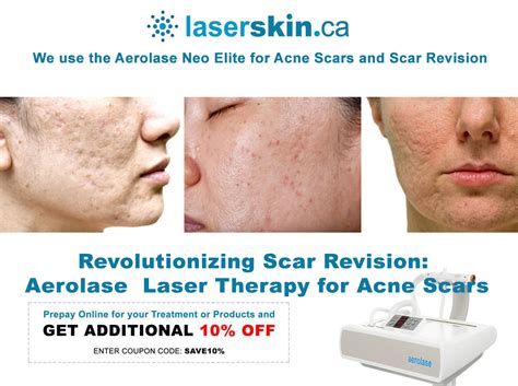 Transforming Your Skin Aerolase Laser For Acne Scar Treatment