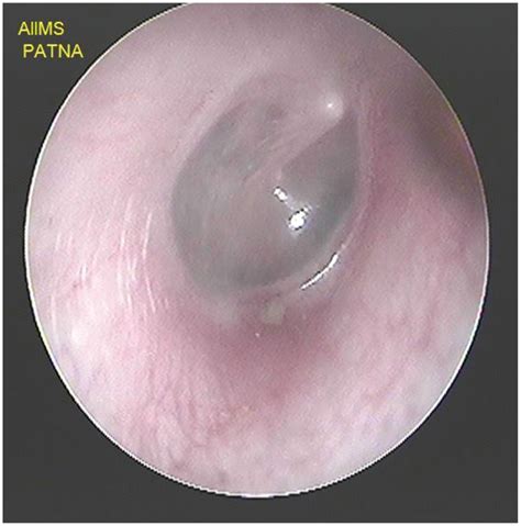 Smartphone Otoscopy Sans Attachment A Paradigm Shift In Diagnosing Ear