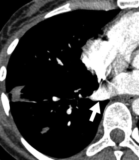 High Resolution Mdct Of Pulmonary Septic Embolism Evaluation Of The Feeding Vessel Sign Ajr