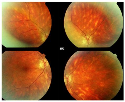 Birdshot Chorioretinopathy