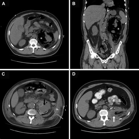 Computed Tomography Of The Abdomen And Pelvis A Transverse And B