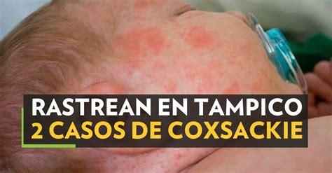 Rastrean En Tampico 2 Casos De Coxsackie