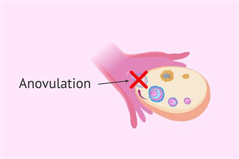 Uterine Polyps: Causes, Symptoms & Treatment | ART Fertility Clinics